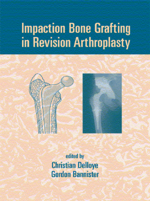 cover image of Impaction Bone Grafting in Revision Arthroplasty